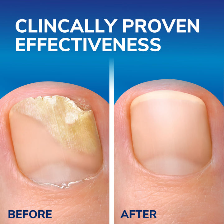 Scholl anti-fungal nail treatment kit with file and brush applicator for targeted care